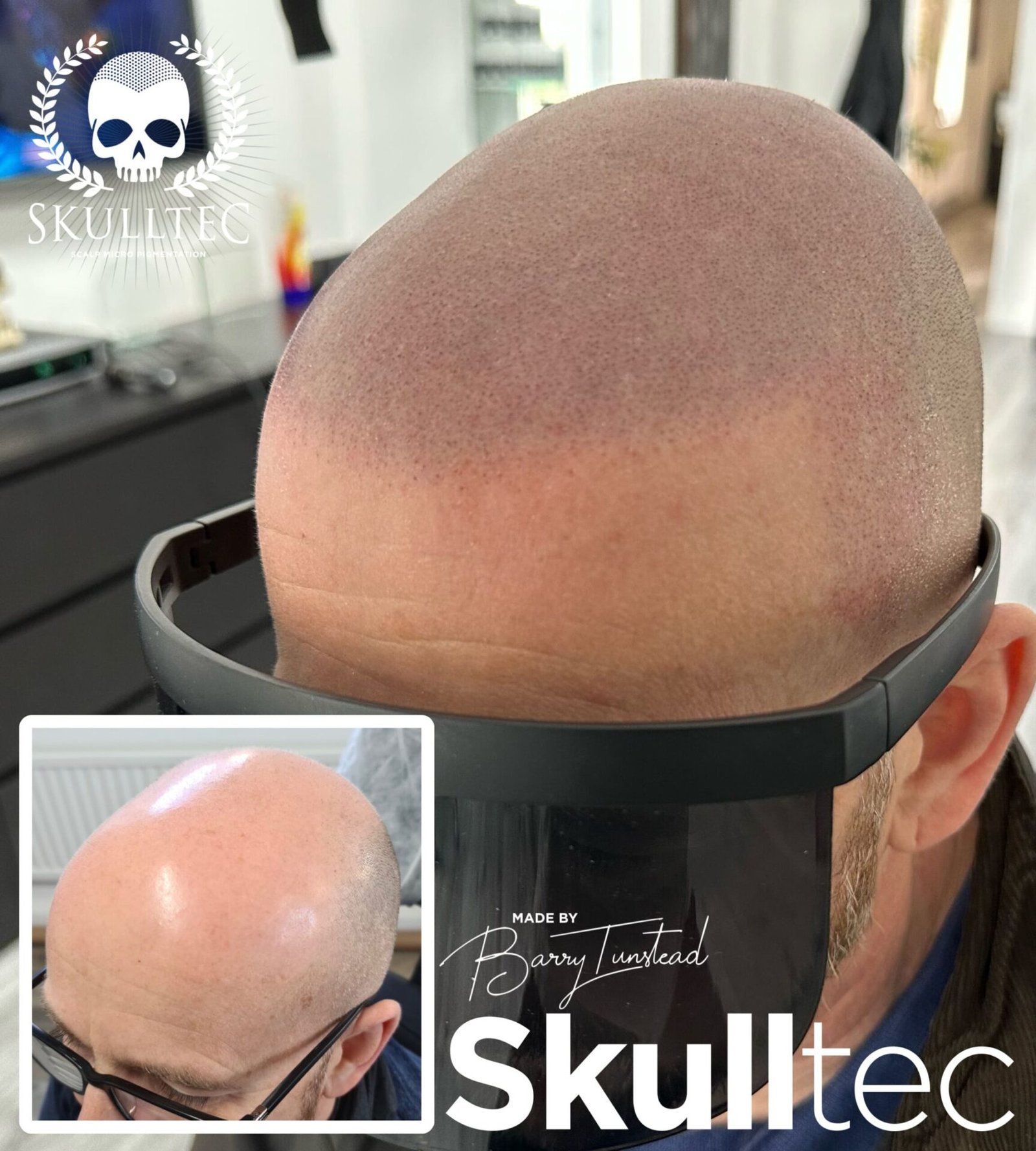 Choosing the Right Scalp Micropigmentation Clinic in London - Skulltec