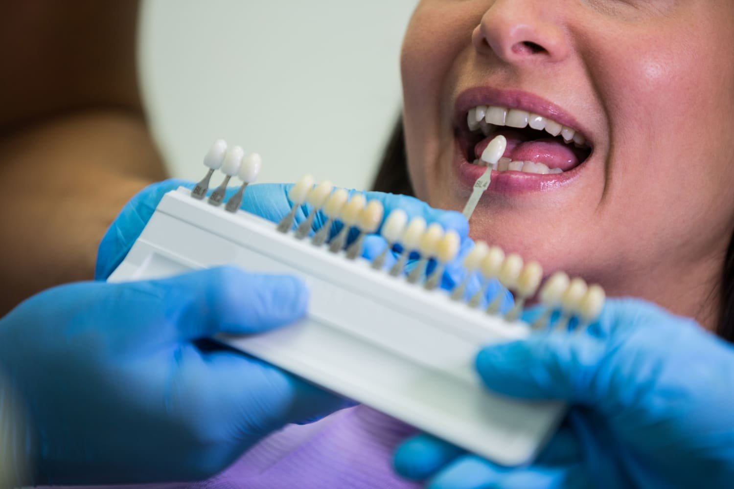 The Best Guide for Dental Veneers in Turkey