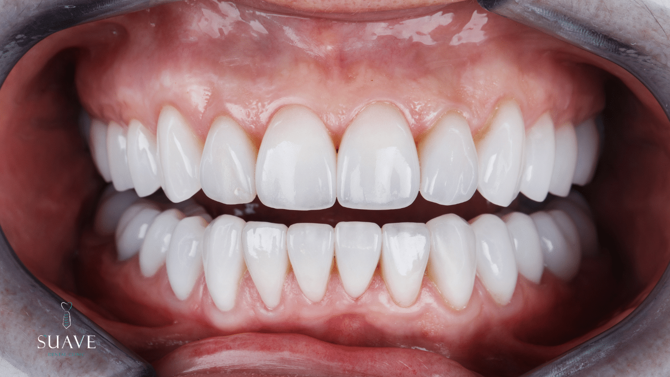 Top 10 best Veneers brands in 2025 - Suave Clinic